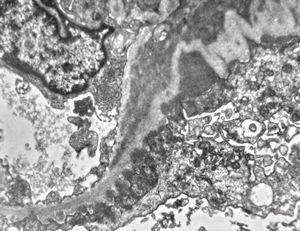 F,40y. | type III membranoproliferative glomerulonephritis F,40y. | type III membranoproliferative glomerulonephritis